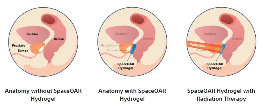 💥New ~ SpaceOAR Vue Hydrogel Spacer Procedure (for prostate CA) from the  Vargo Anesthesia Mega App. - An outpatient procedure in which