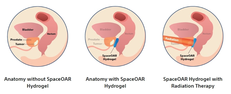 Radiation Treatment Side Effects Minimized by Rectal Spacers